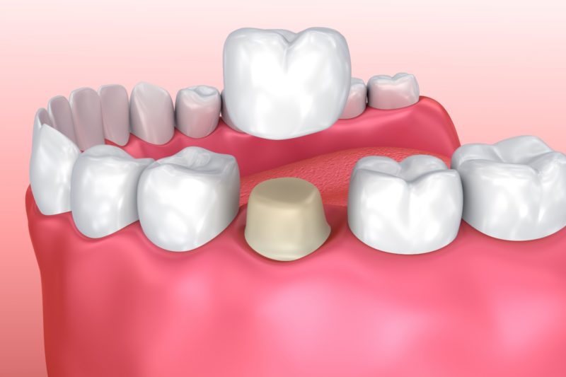 Dental crown installation process
