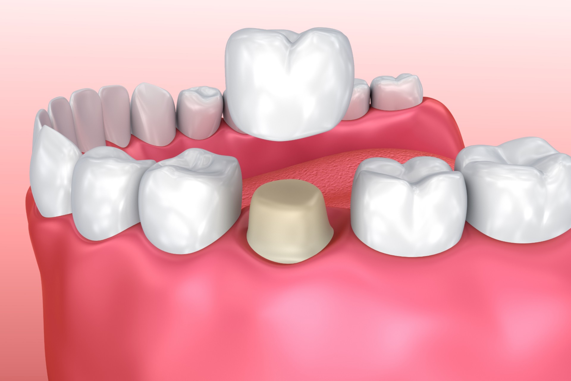 Dental crown installation process