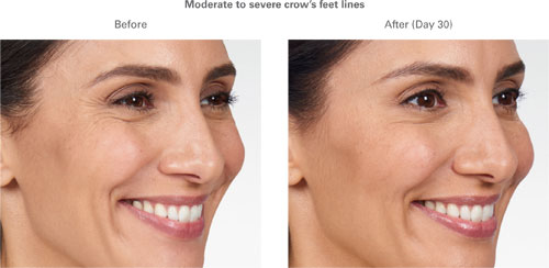 Moderate to severe crow's feet lines