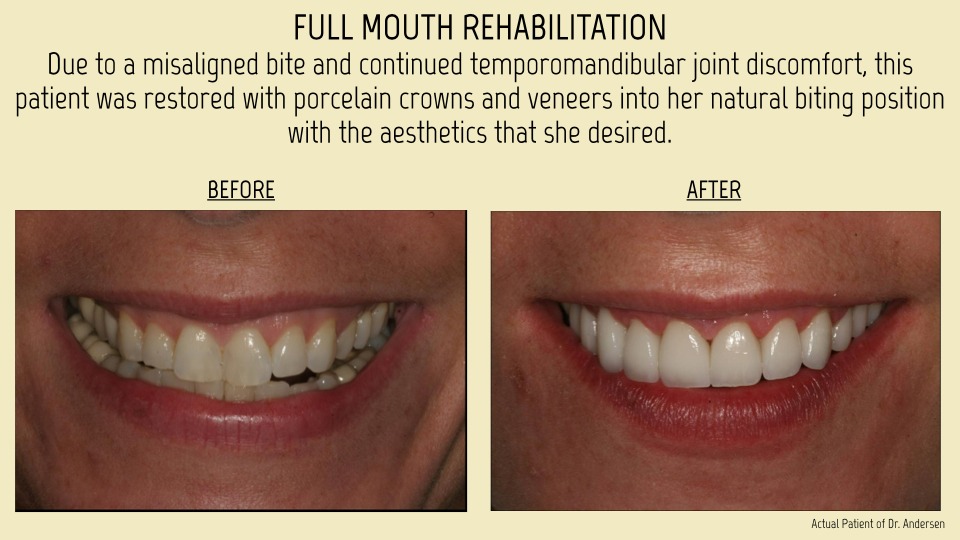 Full mouth Restoration