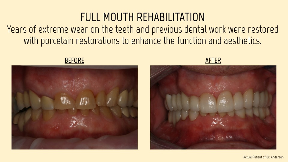 Full mouth rehabilitation
