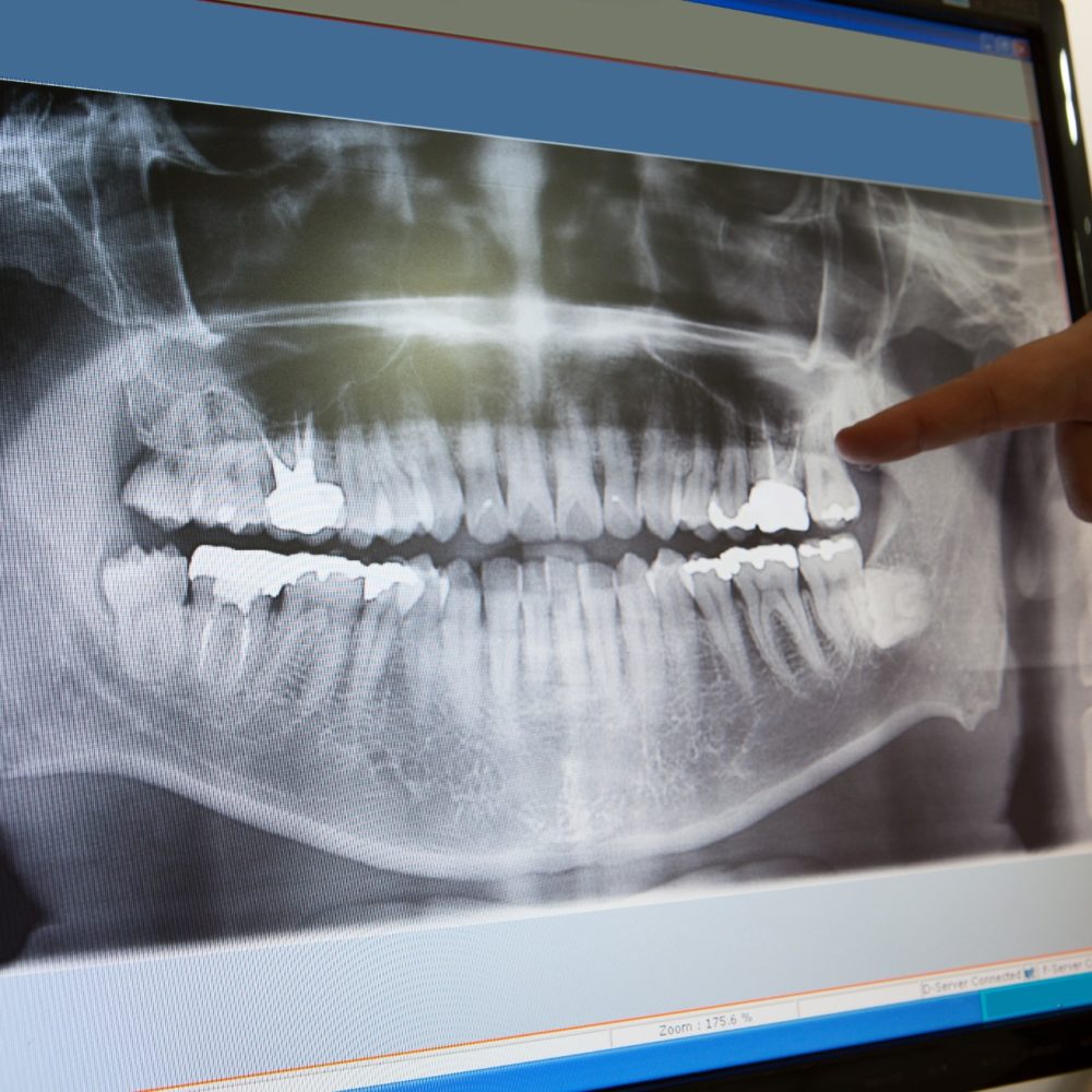 Panoramic dental X-Ray with hands point