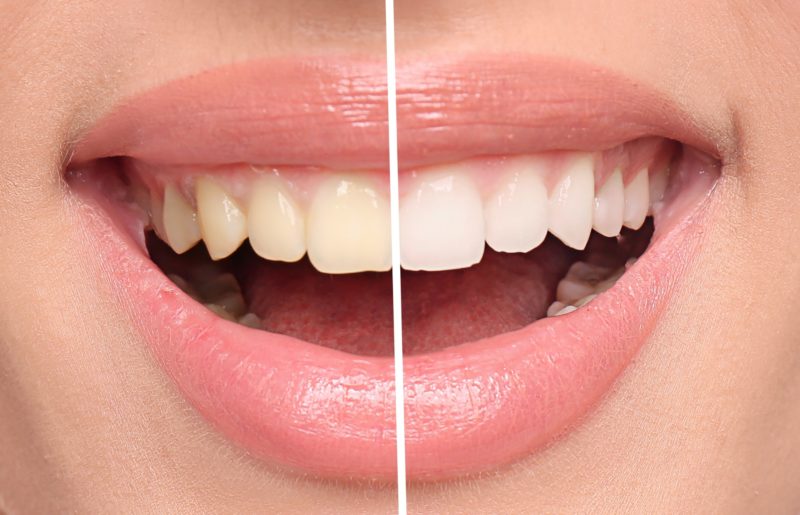 Before and after teeth whitening procedure