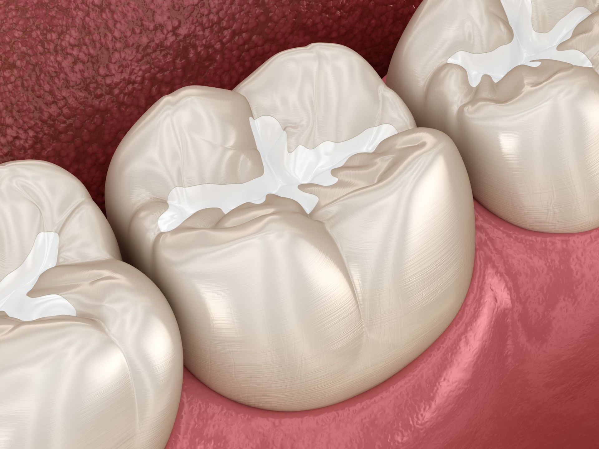 Composite Tooth-Colored Fillings - Artisan Dental
