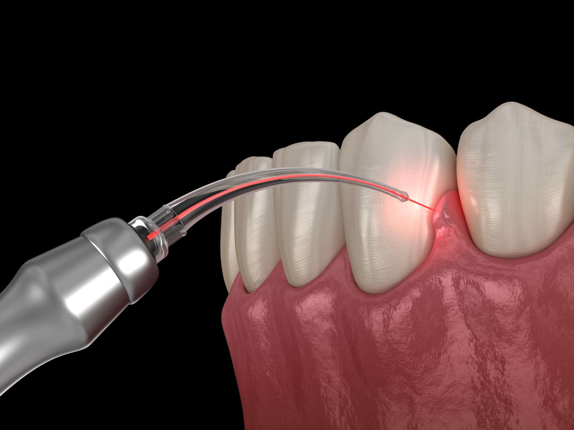 Laser Gum Sculpting - Artisan Dental