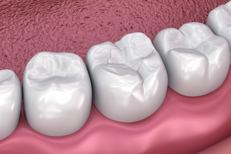 Dental Sealants - Artisan Dental