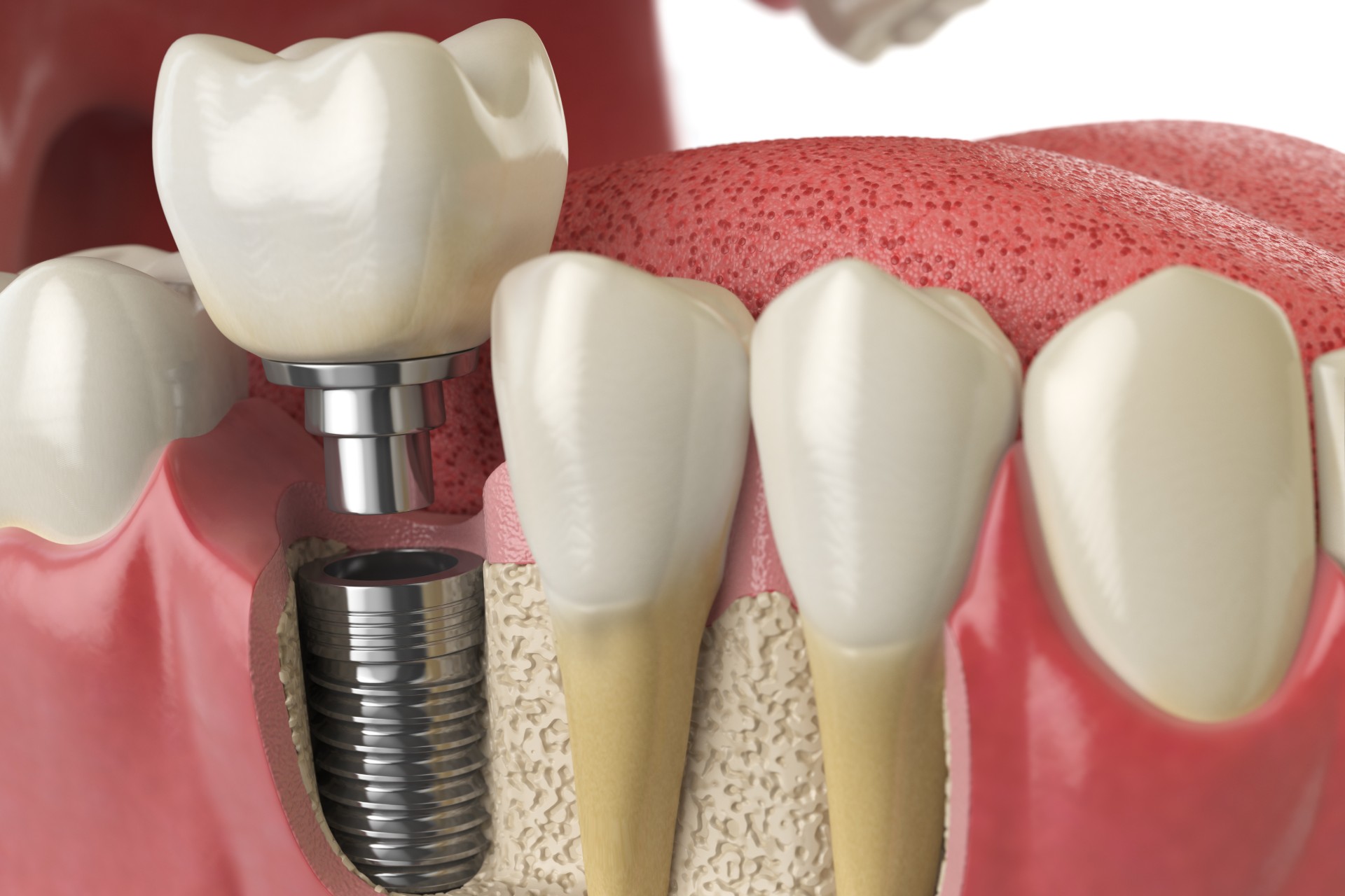 Tooth dental implant in human dentura