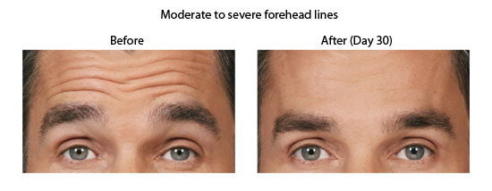 Moderate to severe forehead lines